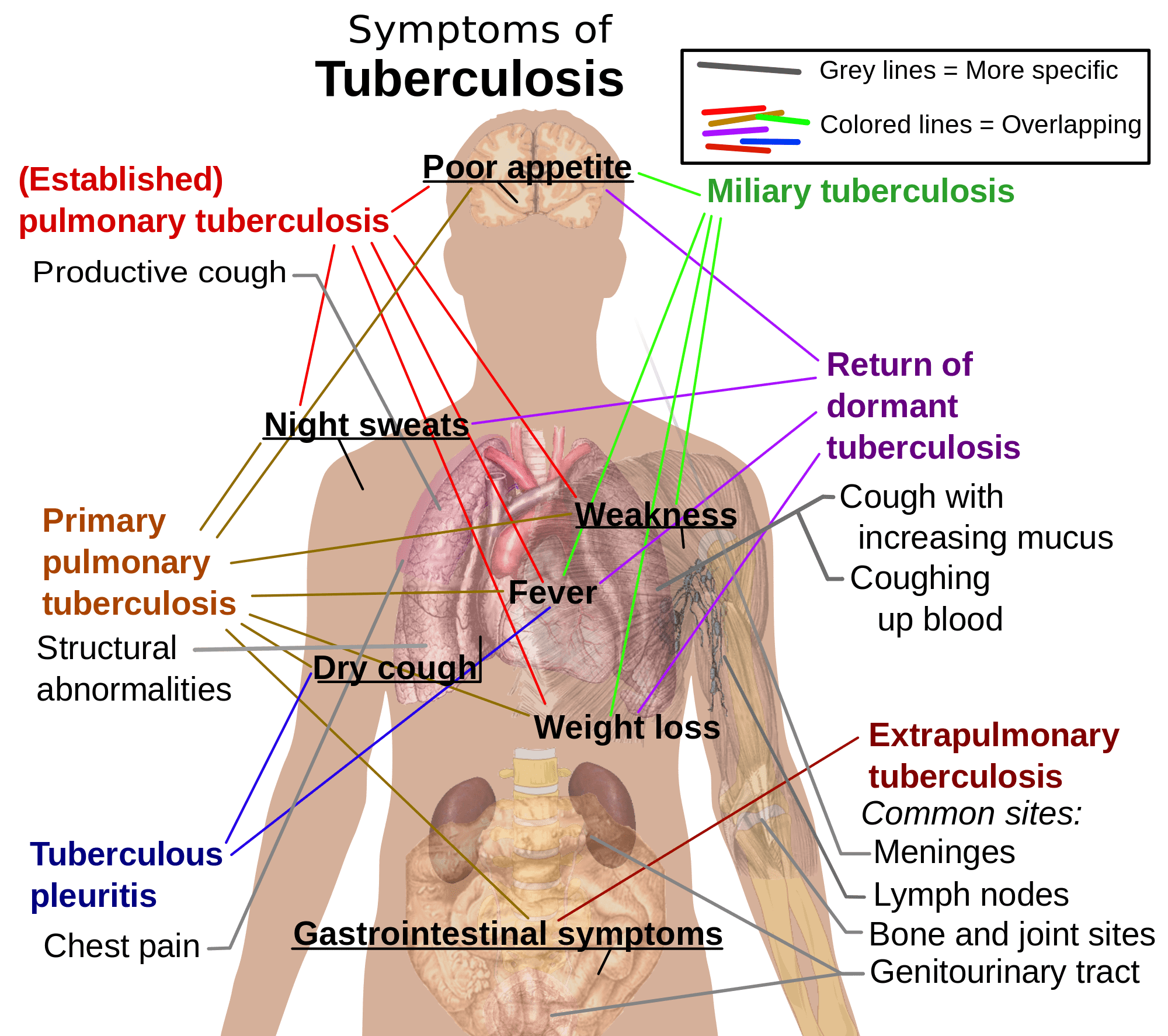 2000px-Tuberculosis_symptoms-virtualdr.ir