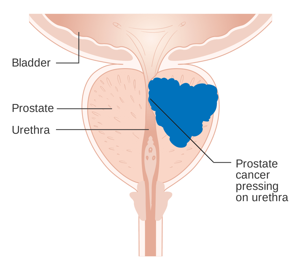 Prostate cancer virtualdr.ir