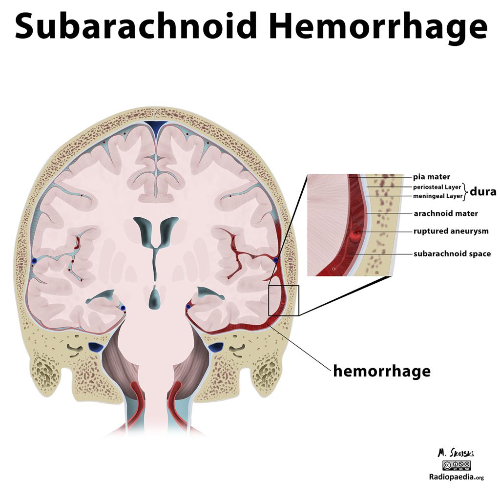 subarchnoid-hemorrhage-VirtualDr.ir