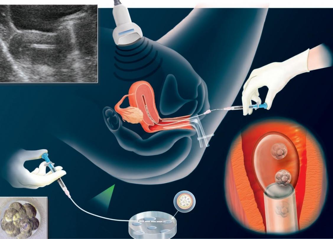 Embryo transfer and Implantation