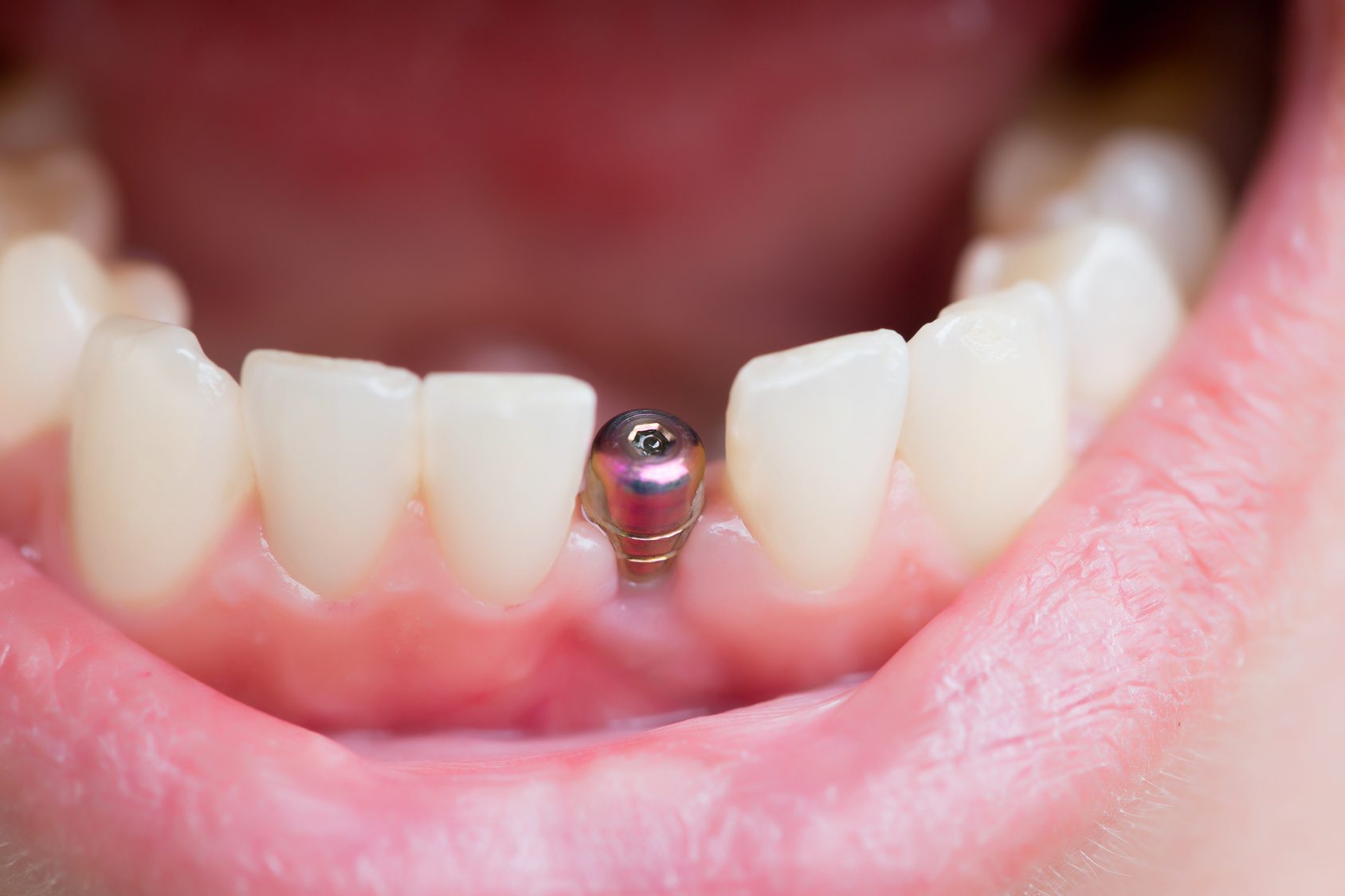 [تصویر:  Georgia_Dental_Implant_Center_April_Sing...Image1.jpg]