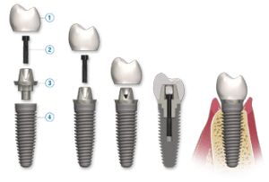 dental-implant-breakdown