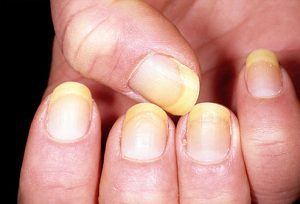 dermnet_photo_of_yellow_nails