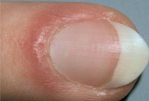 mh_photo_of_red_puffy_nail_fold