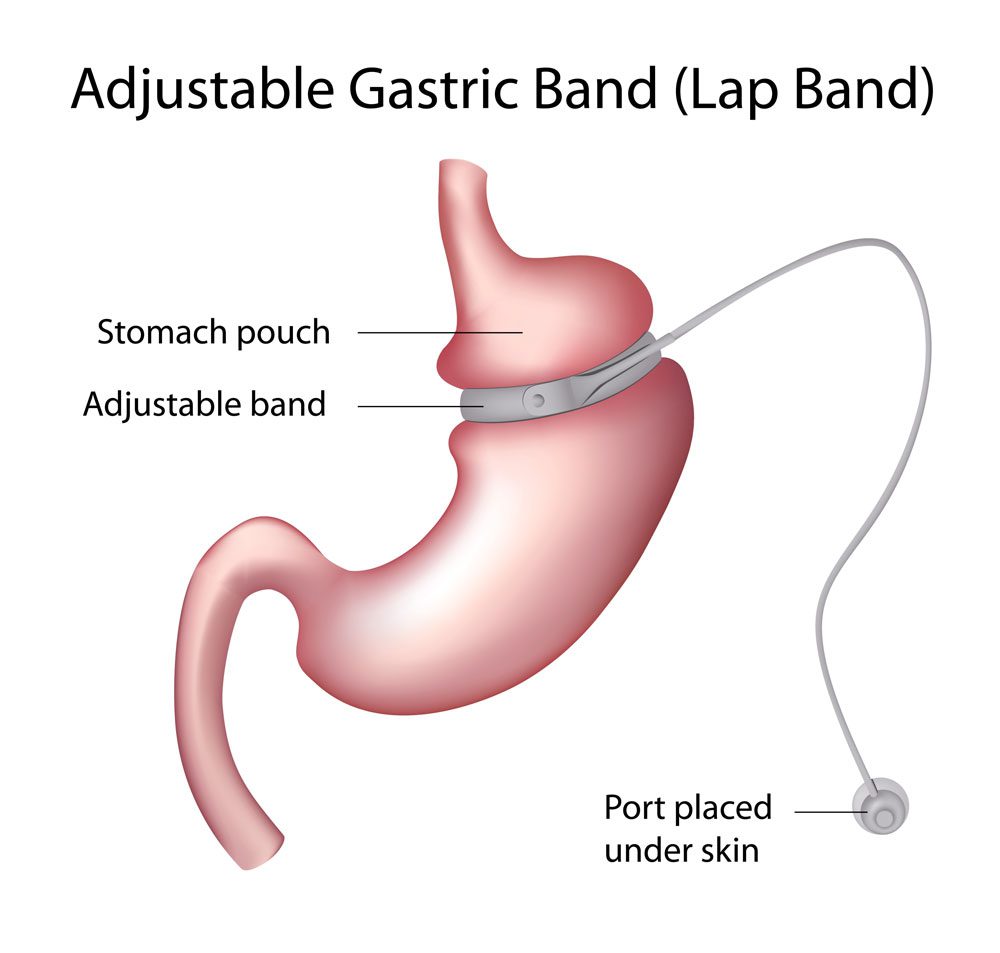 Laparoscopic-Adjustable-Gastric-Banding-virtualdr.ir