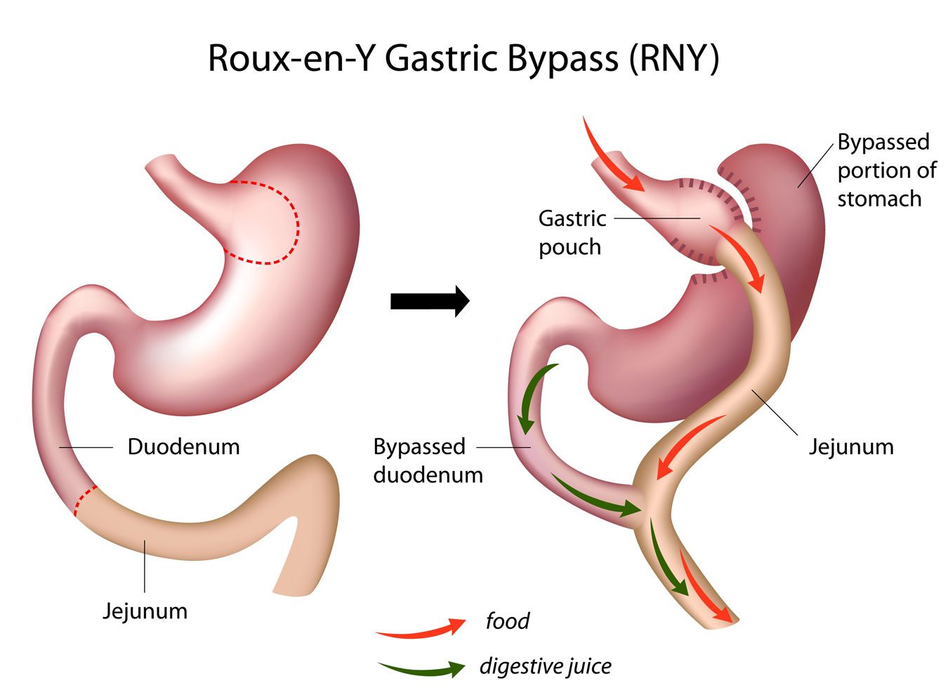 Laparoscopic-Gastric-Bypass-ReY-virtualdr.ir