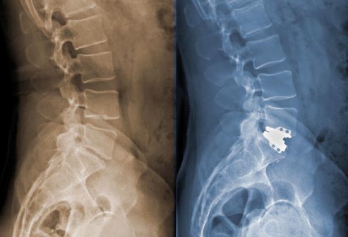 getty_rm_photo_of_post-operative_spine_x-ray-virtualdr.ir