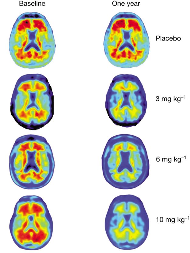 اسکن‌های مغزی اثرات مصرف دوزهای مختلف دارو را پس از یک سال نشان می‌دهند