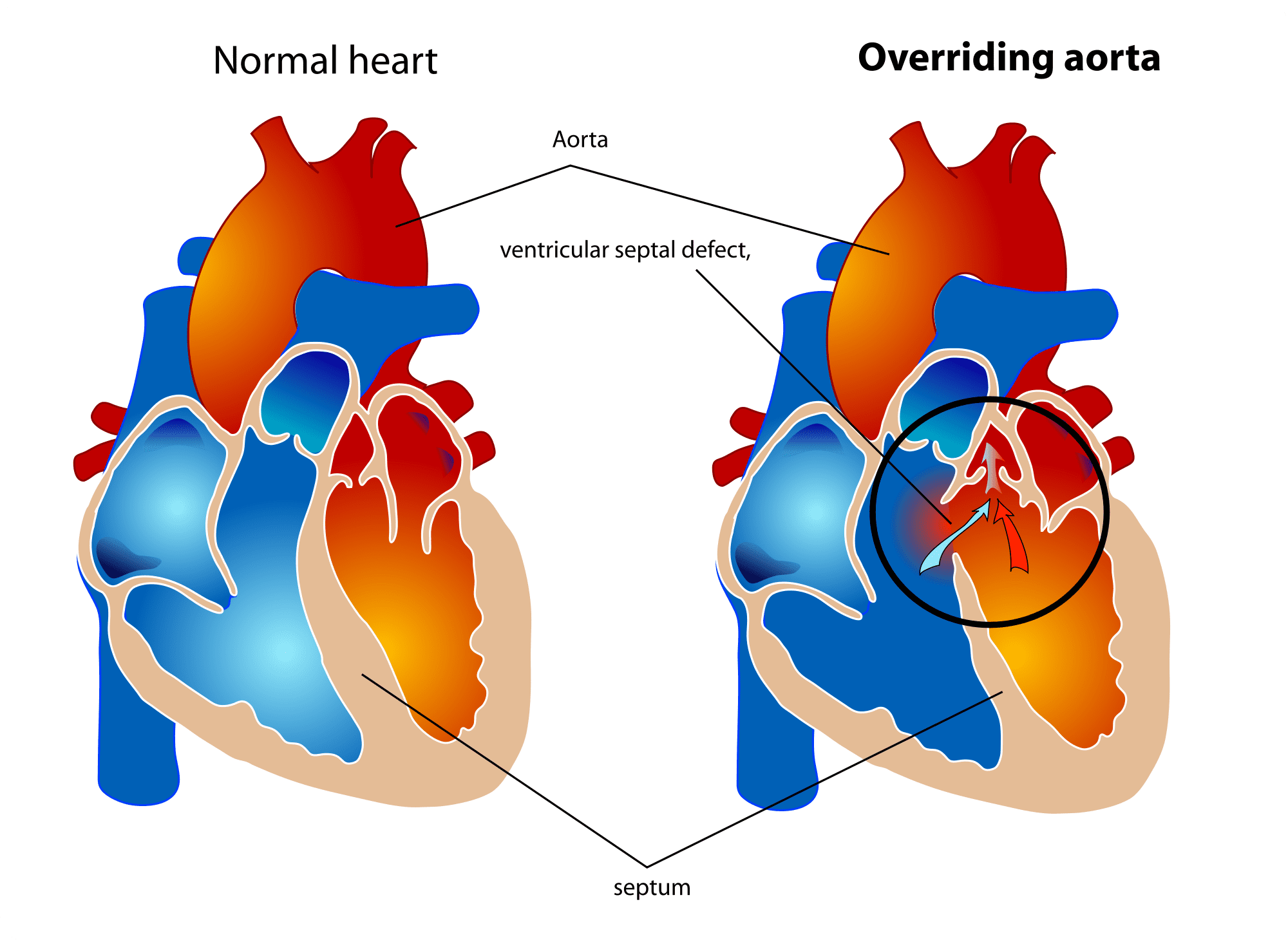 2000px-overriding_aorta_diagram-svg