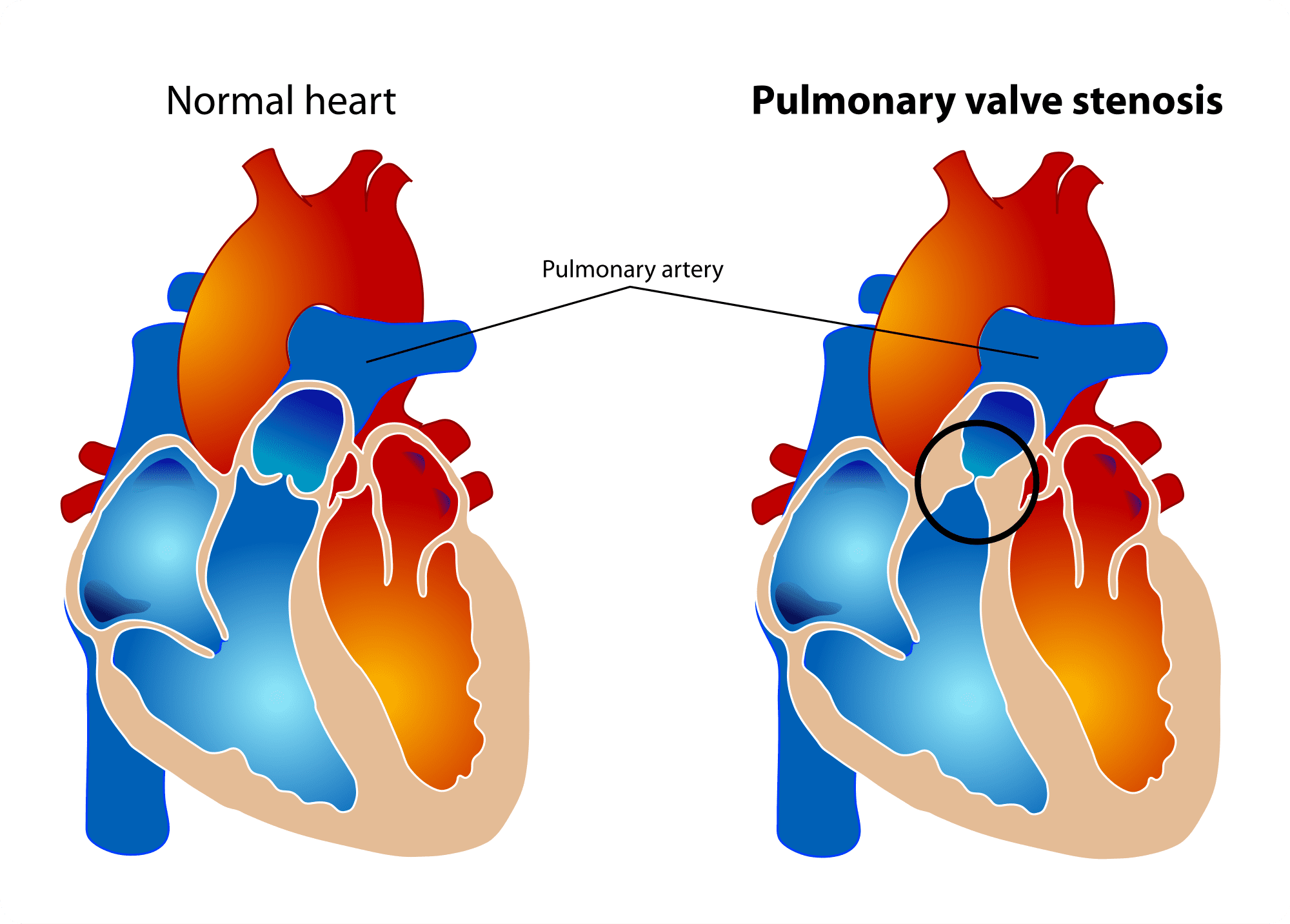 2000px-pulmonary_valve_stenosis-svg
