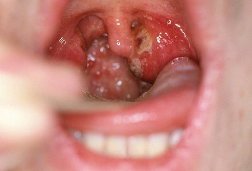 493ss_science_source_rm_photo_of_strep_throat