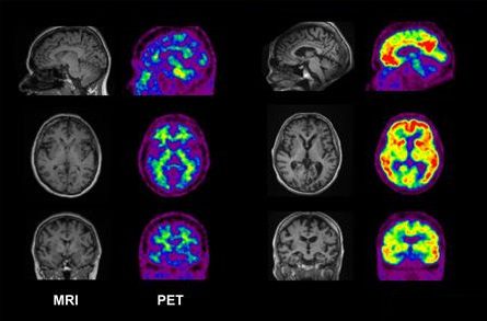 مقایسه‌ی اسکن‌های مغزی افراد سالم (چپ) و مبتلایان به بیماری‌های زوال عقلی