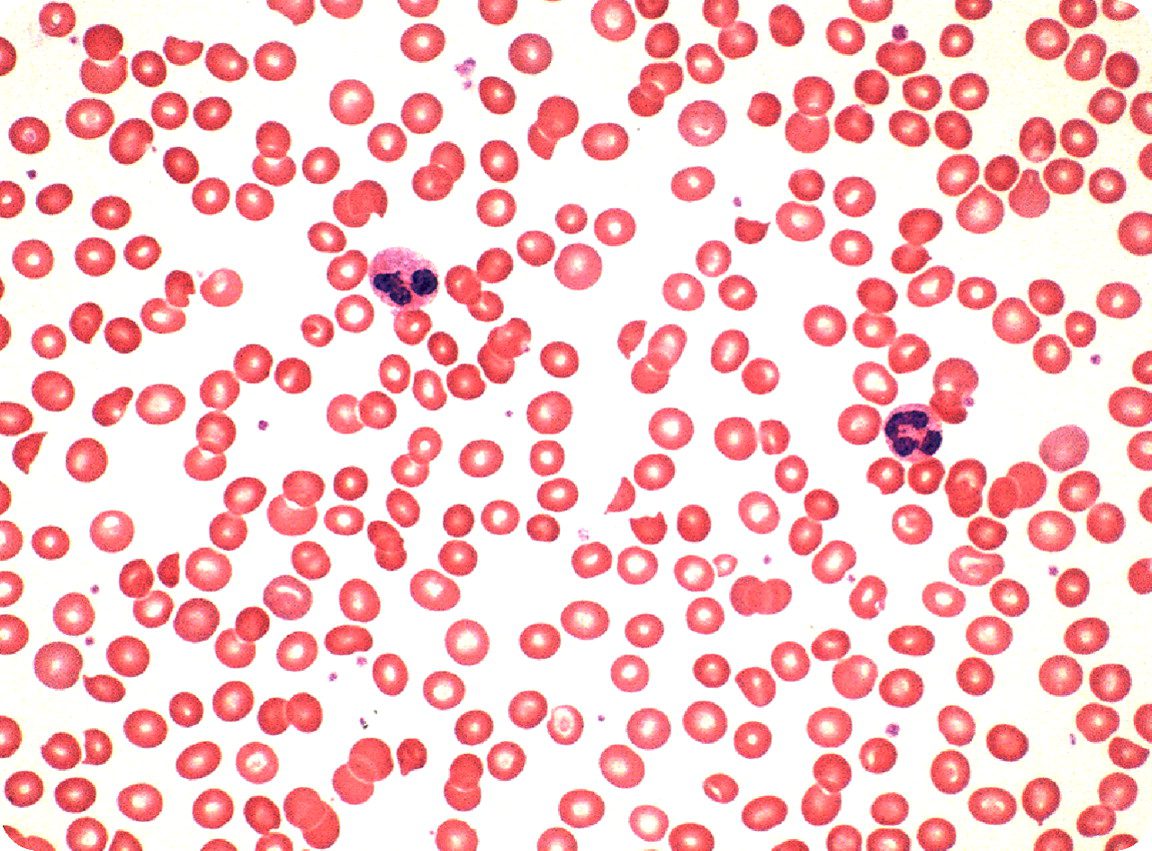 hemolytic_anemia_example