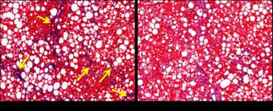 به موش‌ها غذاهای پرچرب و پر از قند داده شده تا وضعیت زیر پیش بیاید. در سمت چپ، رنگ‌آمیزی فیبروزها را با ساختارهای تیره نشان داده (با فلش مشخص شده‌اند). در سمت راست با خاموش گردن TAZ فیبروز بازگشته است. (اعتبار تصویر متعلق به Dr.wang از مرکز پزشکی دانشگاه کلمبیا می‌باشد.)