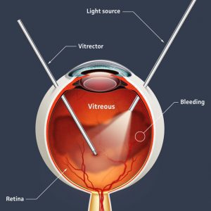 ویترکتومی. در این عمل، جراح زجاجیه چشم را خارج کرده و آن را با محلولی نمک‌دار جایگزین می‌کند.