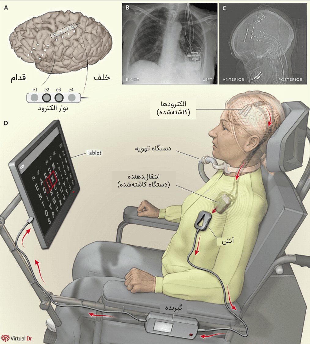 brain-implant-helps-a-paralyzed-woman-communicate-at-home-virtualdr-ir