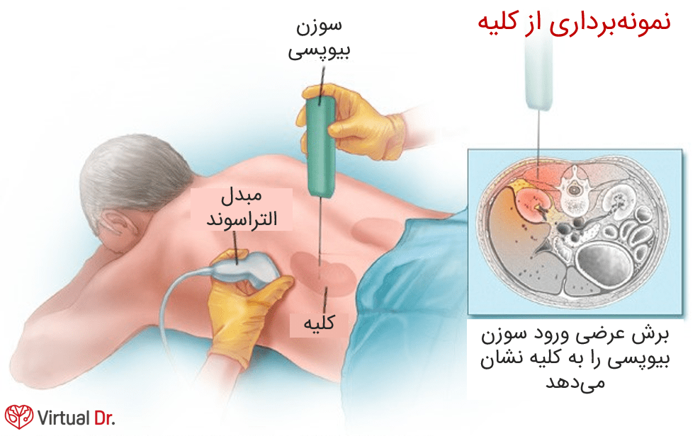 kidney-biopsy-virtualdr-ir