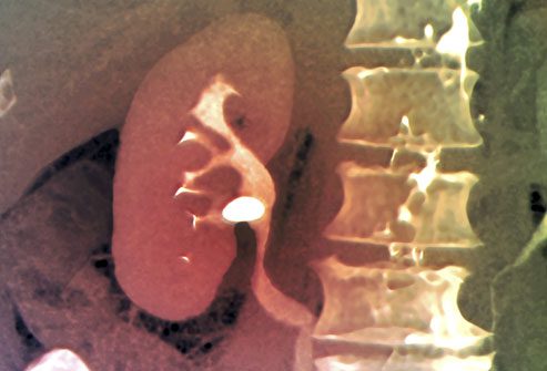princ_rm_photo_of_ct_scan_of_kidney