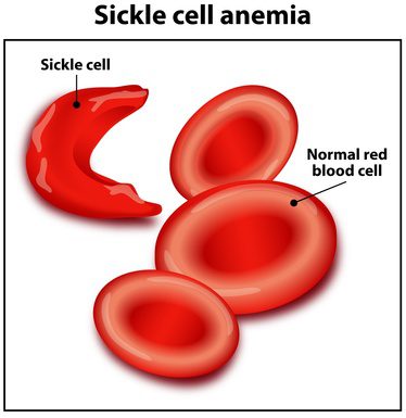 sickle-and-normal-red-cell-virtualdr