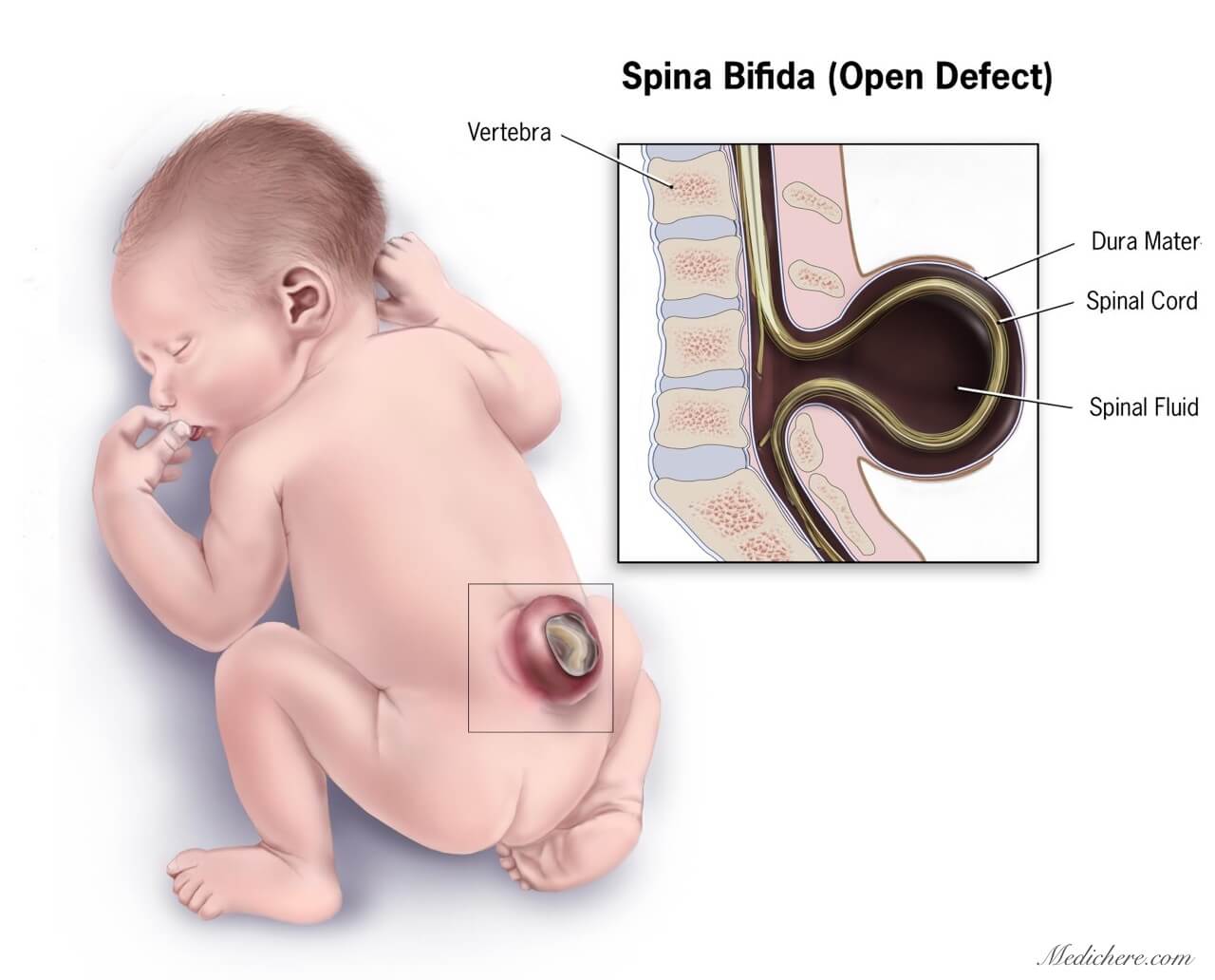 Spina_bifida-virtualdr