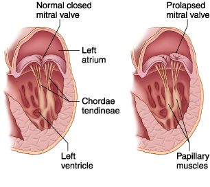 mitral_valve_prolapse-virtualdr