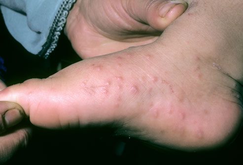phototake_hand-foot-mouth_disease_foot_rash