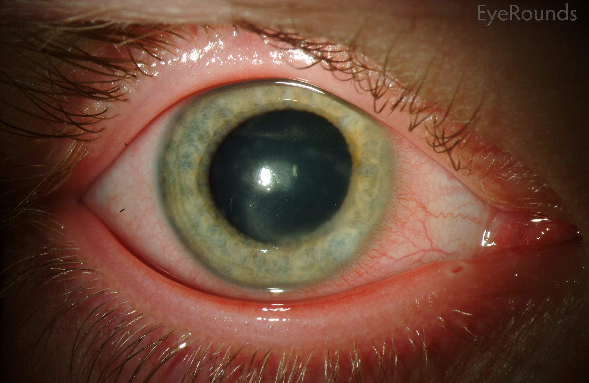 How Do You Get Herpes Viral Keratitis