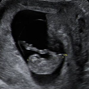 سونوگرافی جنین هفته نهم