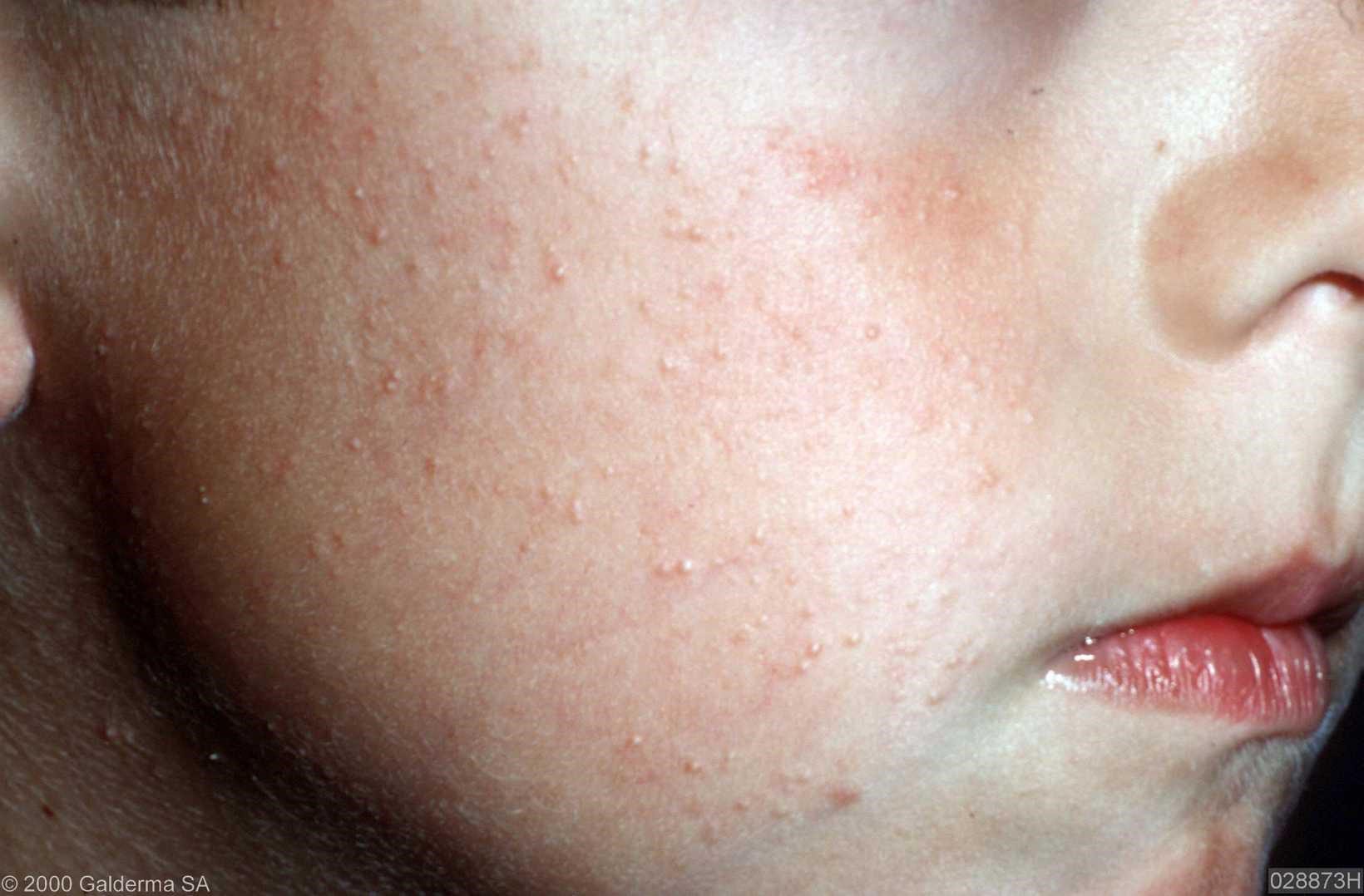 کراتوز پیلاریس