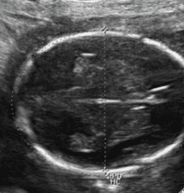 virtualdr.ir/pregnancy week 18 ultrasound
