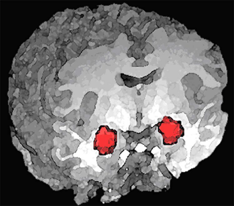 عکس جایگاه آمیگدال در مغز را نشان می‌دهد. گروه با استفاده از ابزارهای جدید تحقیقی چگونگی کنترل آمیگدال بر هیجانات و رفتارهای اجتماعی و همچنین به هم خوردن آن را در بیماریهای ذهنی مثل اختلالات طیف اوتیسم و افسردگی مورد بررسی قرار داده‌اند.