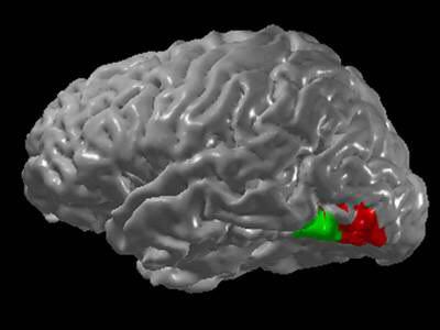 افزایش فعالیت متقاطع در نواحی مغز افراد مبتلا به حس‌آمیزی حروف رنگی