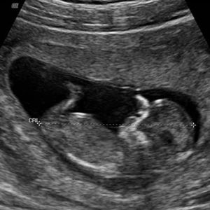 سونوگرافی جنین هفته دوازدهم
