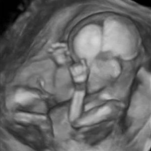 سونوگرافی جنین هفته پانزدهم