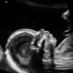 سونوگرافی جنین هفته شانزدهم