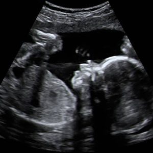 سونوگرافی جنین هفتۀ بیست و سوم