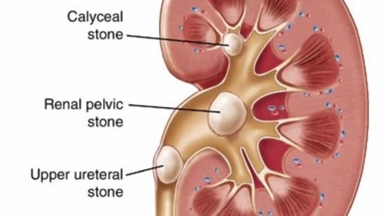 image of kidney stone in ureter