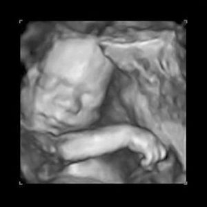 سونوگرافی جنین هفته سی و یکم