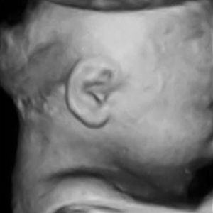 سونوگرافی جنین هفته 35ام