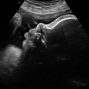 سونوگرافی جنین هفته 36ام