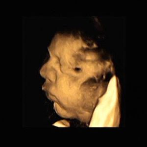 سونوگرافی جنین هفته 39