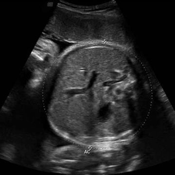 سونوگرافی جنین هفته 41