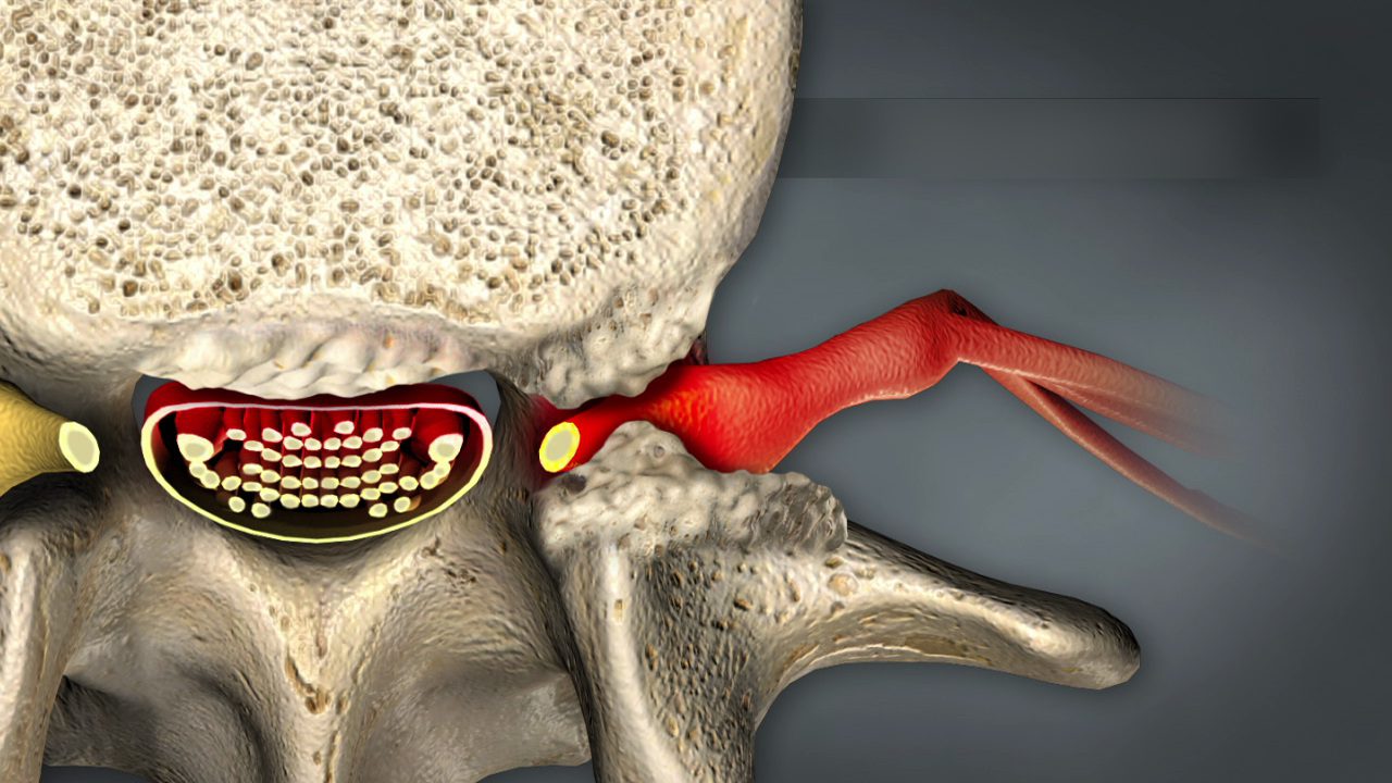 تنگی کانال نخاعی چیست؟ علائم ، تشخیص و درمان تنگی کانال نخاعی دکتر مجازی