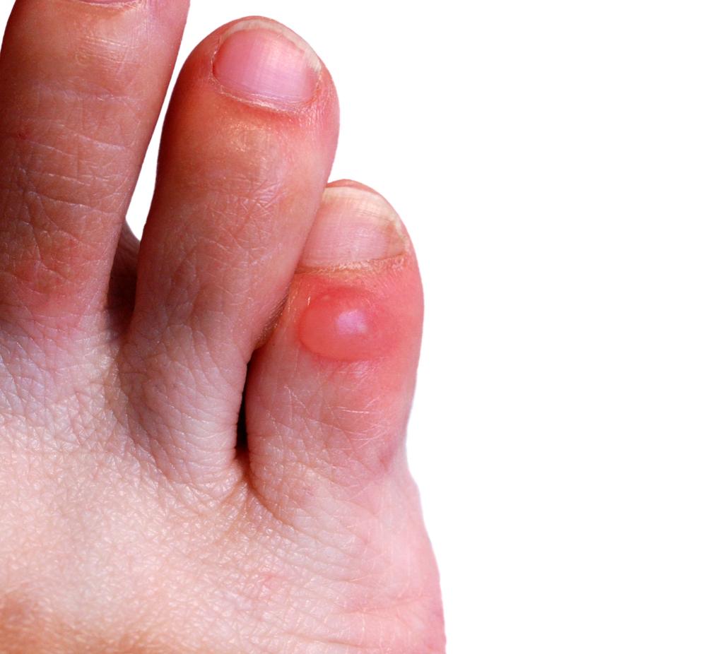 5-ways-to-prevent-a-blister-on-bottom-of-foot-blister-on-bottom-of