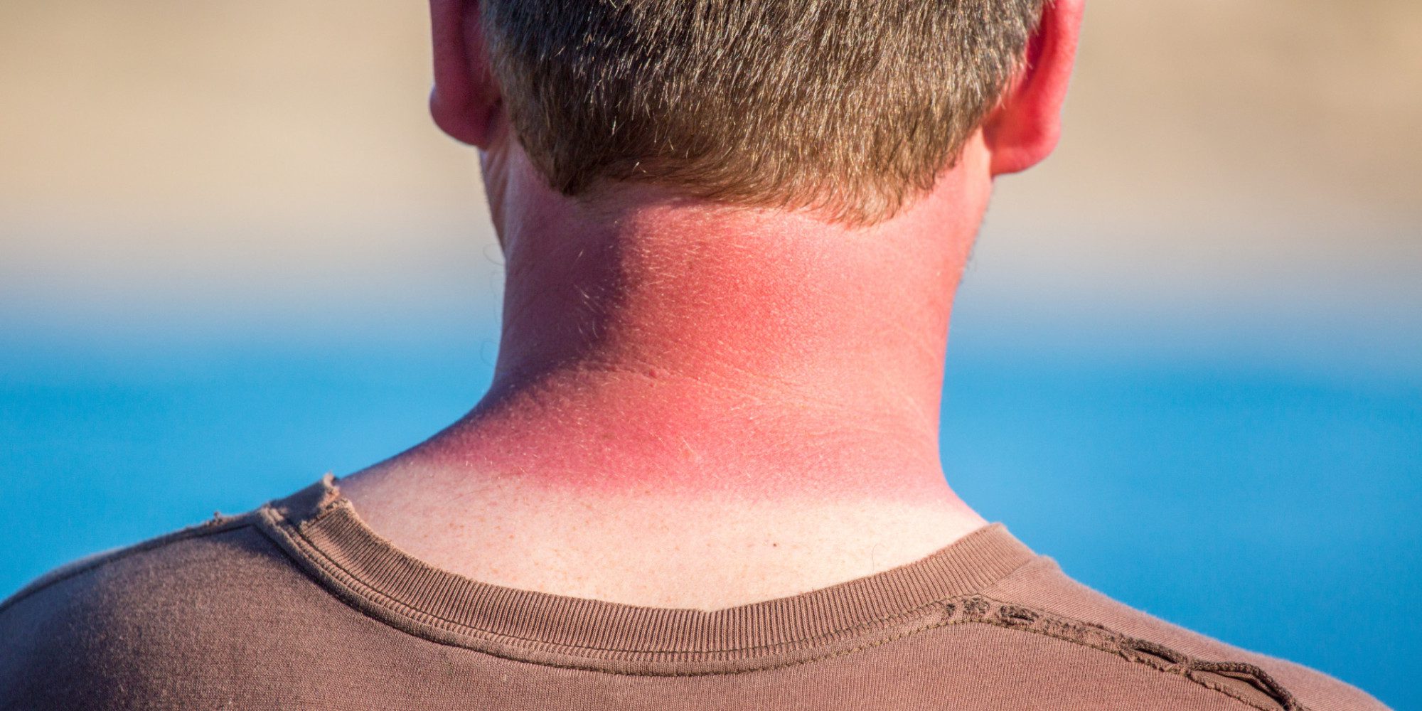 بهبود آفتاب سوختگی چقدر طول می‌کشد؟