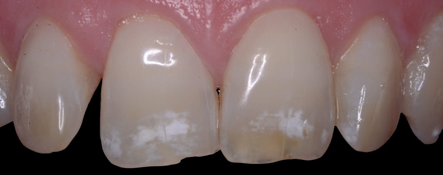 نقاط سفید بر روی دندان‌ها