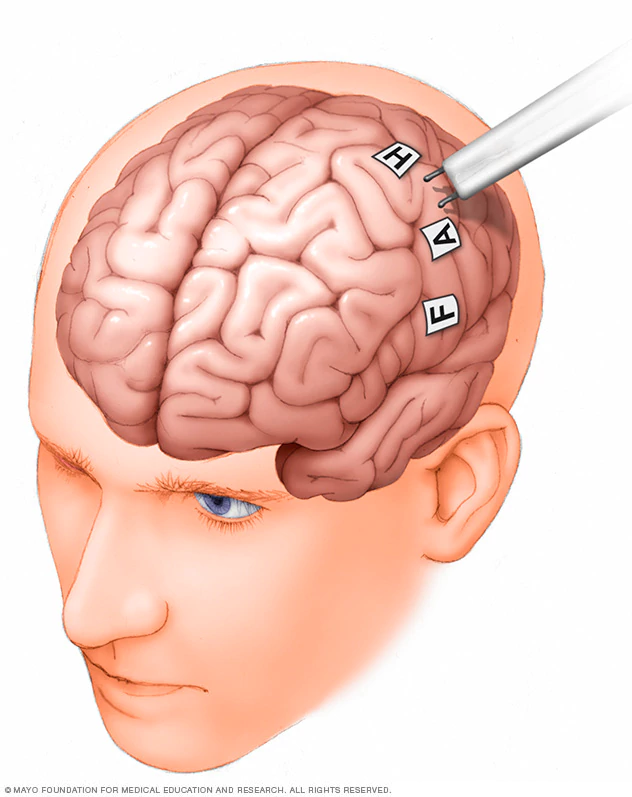 نقشه بندی مغز در جراحی مغز در حالت بیداری