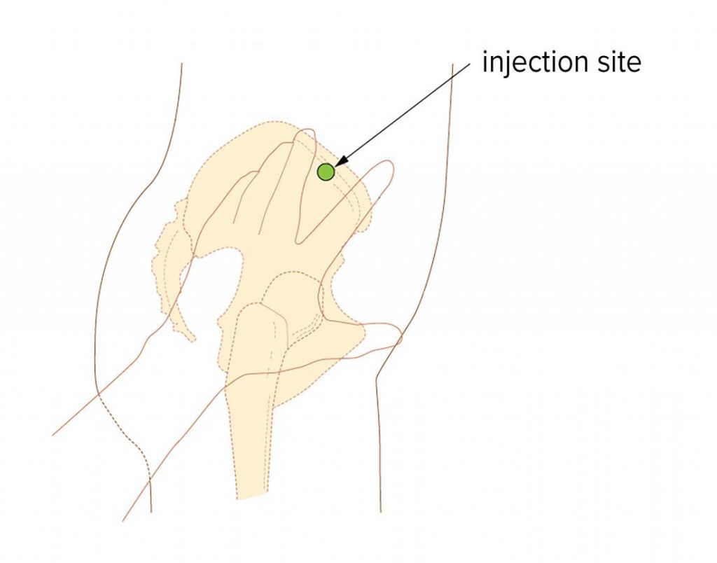 محل دقیق تزریق عضلانی در قسمت مفصل ران در لگن