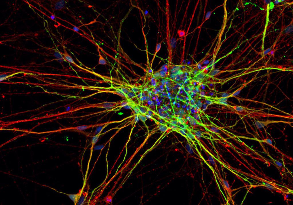 رشد نورونها در بیماری اوتیسم