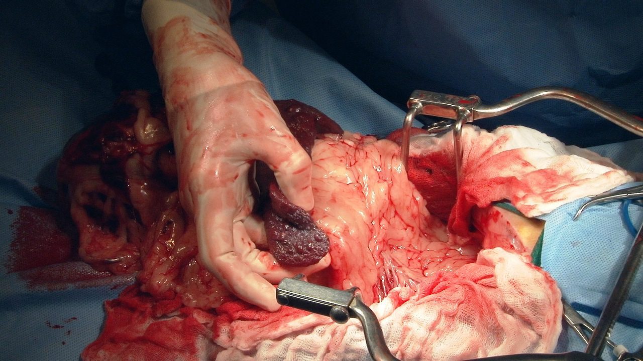 عمل جراحی اسپلنکتومی چیست و چگونه انجام می‌شود؟
